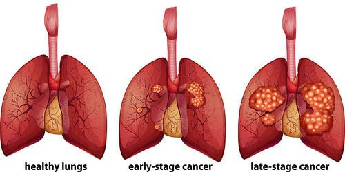 Có các triệu chứng này, ung thư phổi đã ở giai đoạn cuối - 1