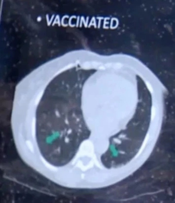 So ảnh X-quang của người đã tiêm và chưa tiêm vaccine Covid-19, rút ra kết luận kinh ngạc-2