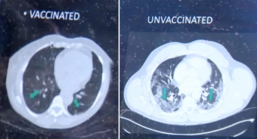 Hình ảnh chụp phổi thể hiện hiệu quả của vắc xin Covid-19