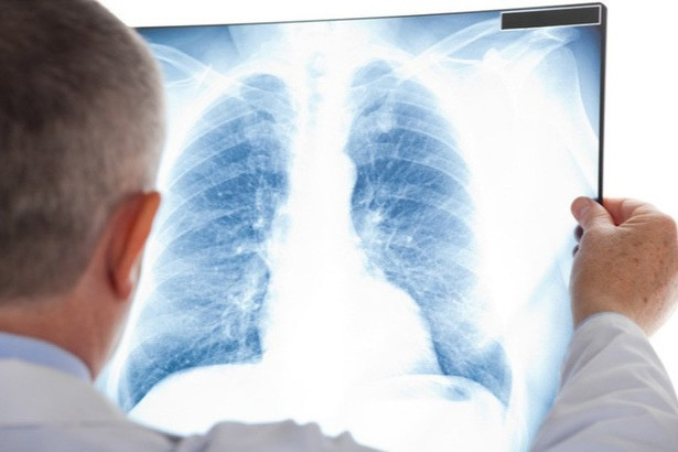 Dấu hiệu bệnh ung thư phổi tái phát - 1