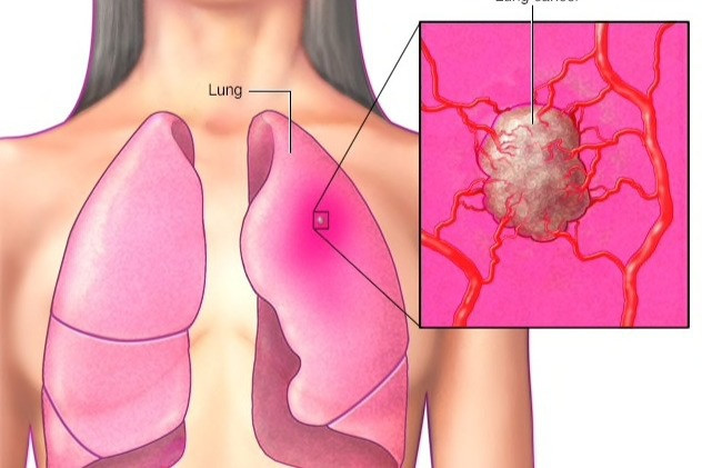 Các triệu chứng thường gặp của ung thư phổi ở nữ giới - 1