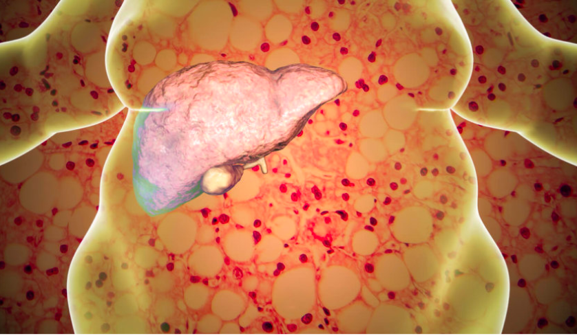 6 việc giúp loại bỏ sớm bệnh gan nhiễm mỡ: Sau Tết là thời điểm tốt nhất để làm - 3
