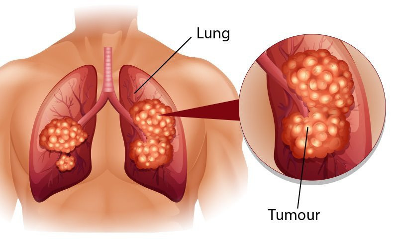 Khối u carcinoid phổi là gì? - 1
