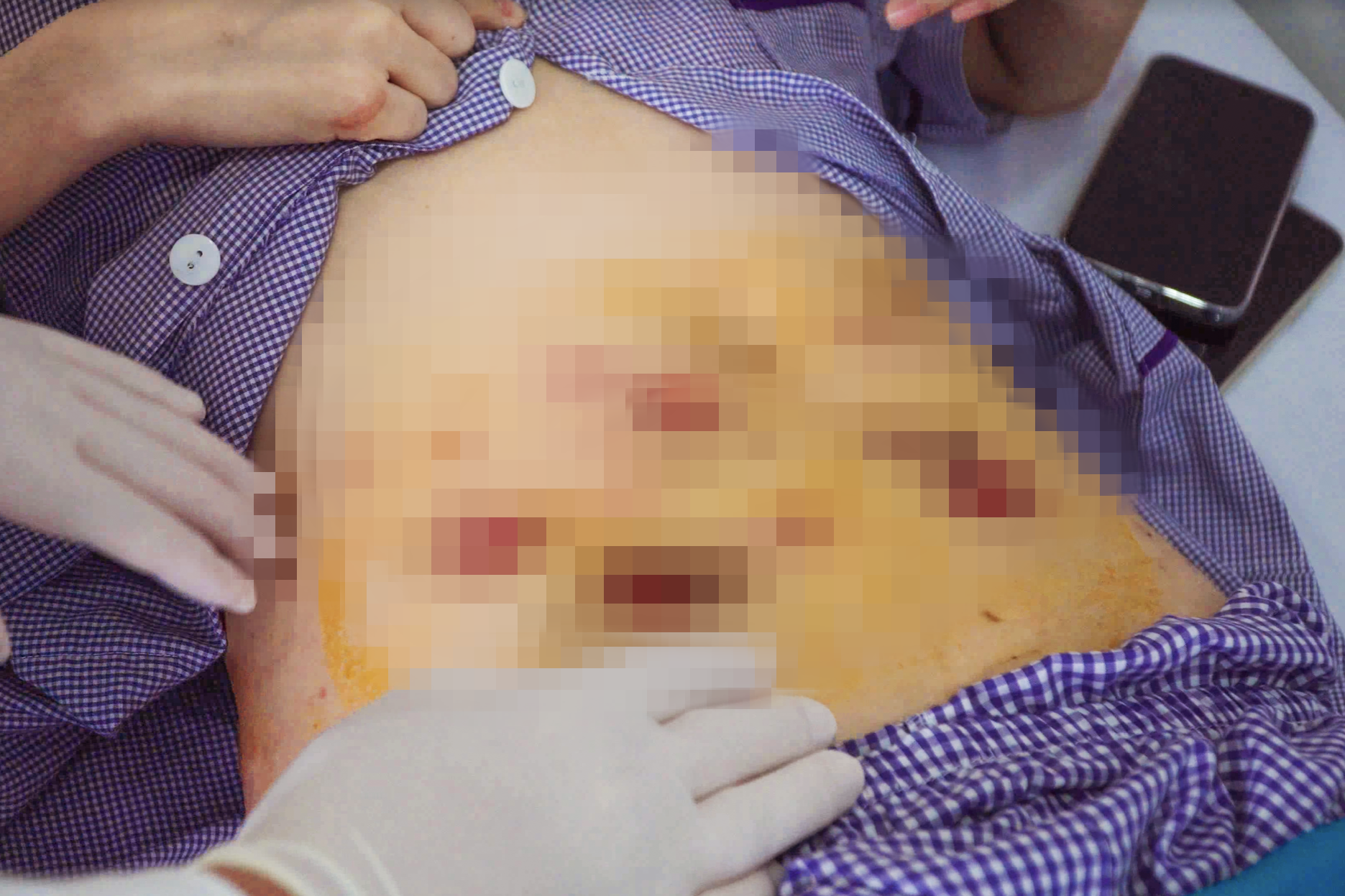 Qua Campuchia tiêm tan mỡ làm đẹp, cô gái bị khoét hàng chục lỗ trên bụng - 1