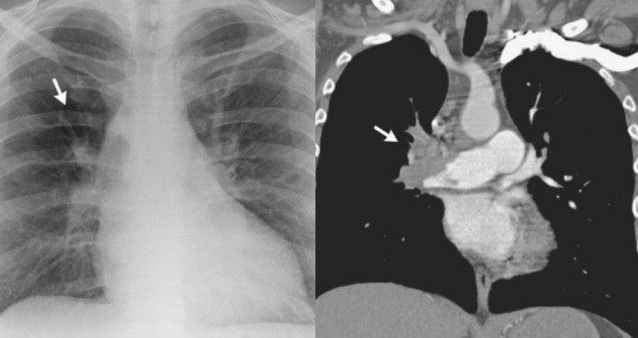 Chàng trai 25 tuổi suýt chết vì ho ra máu hậu Covid-19 - 1