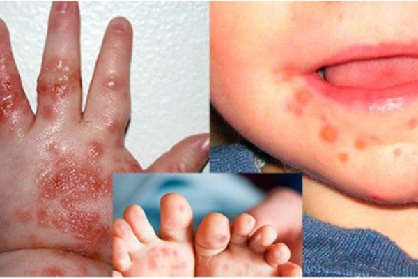 Trẻ có thể bị tay chân miệng và sốt xuất huyết cùng lúc không? Phân biệt vết loét do tay chân miệng gây ra-1