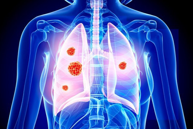 12 dấu hiệu cảnh báo ung thư phổi - 1