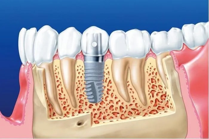 Giáo sư Per Ingvar Branemark đã tìm ra chất liệu cấy ghép Implant bằng Titanium vào năm 1952.