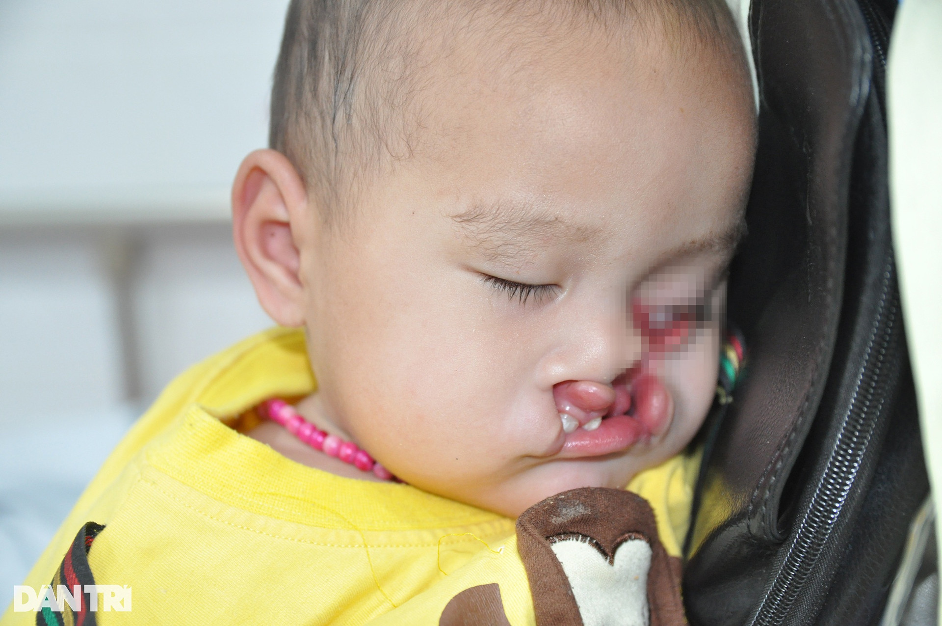 Tiếng cầu cứu của bé gái 1 tuổi dân tộc Mông mang dị tật khe hở chéo mặt - 3