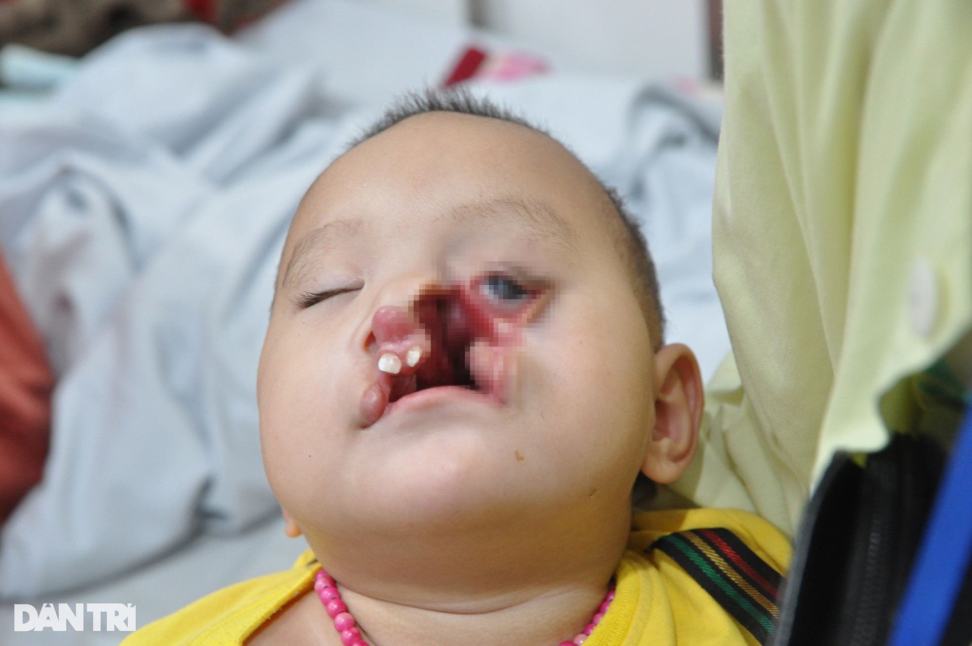 Tiếng cầu cứu của bé gái 1 tuổi dân tộc Mông mang dị tật khe hở chéo mặt - 1