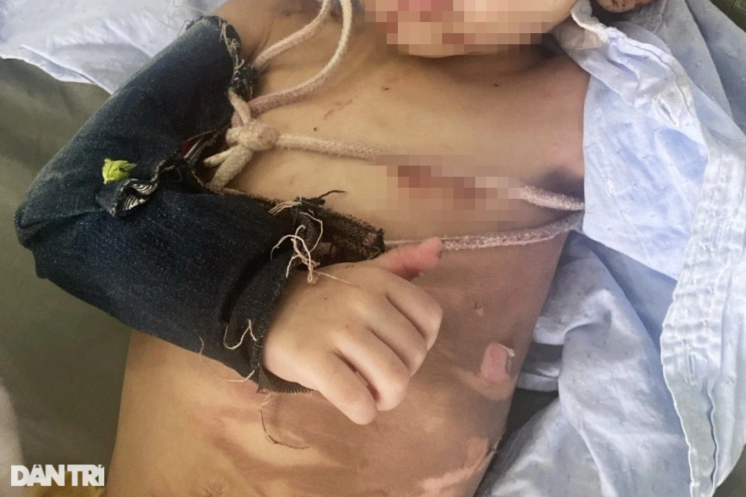 Cấp cứu bé 2 tuổi ở TPHCM người đầy vết thương, nghi bị cha bạo hành 3 ngày - 1