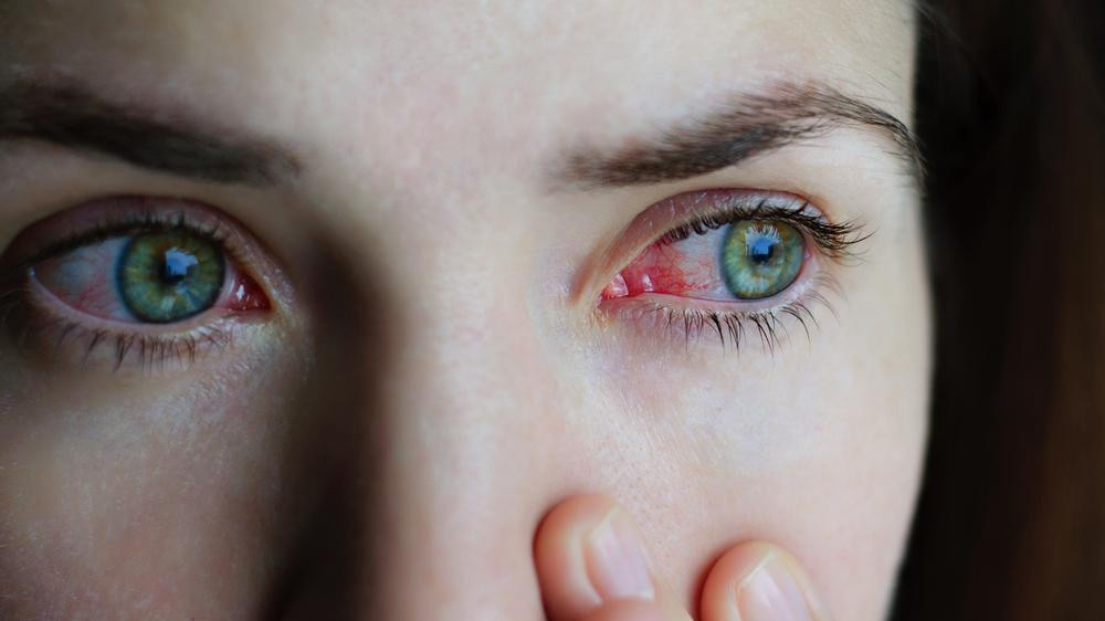 Khi nào dùng kháng sinh trị đau mắt đỏ? - Ảnh 2.