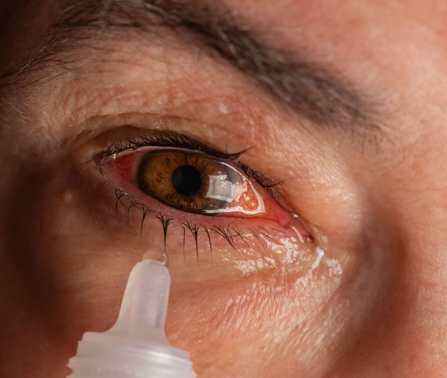 Khi nào dùng kháng sinh trị đau mắt đỏ? - Ảnh 3.