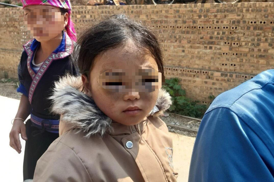 Xác minh vụ bé gái lớp 1 nghi bị cô giáo đánh thâm tím 2 mắt ở Yên Bái - 1