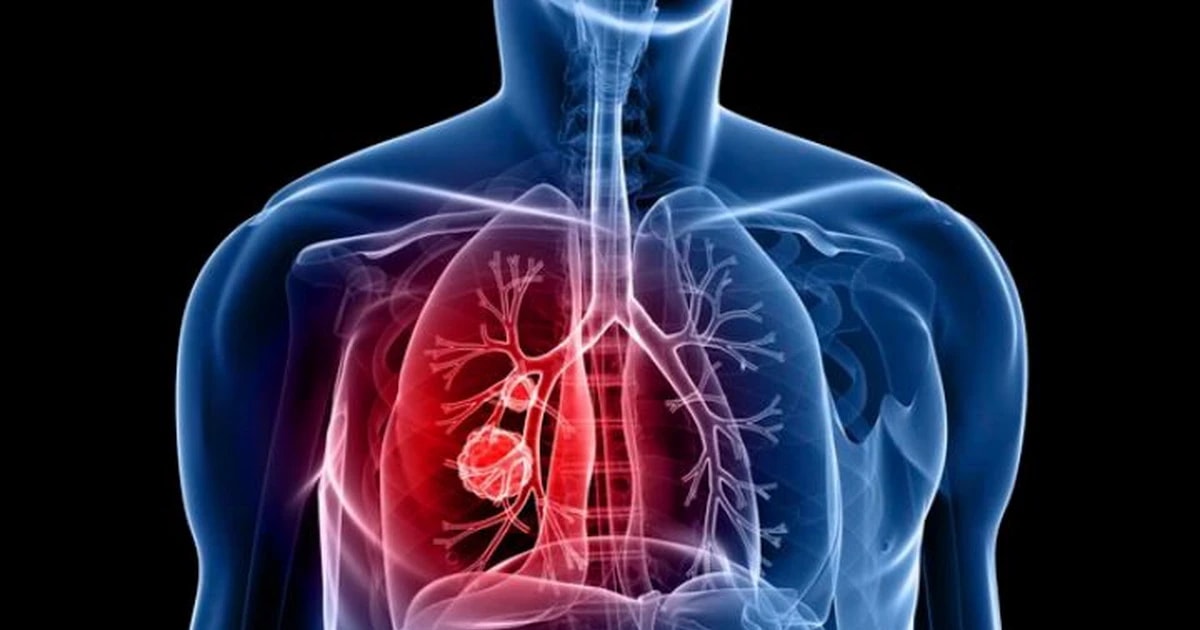 Cuba: Vaccine điều trị ung thư phổi giúp tăng tỷ lệ sống sót lên hơn 85%