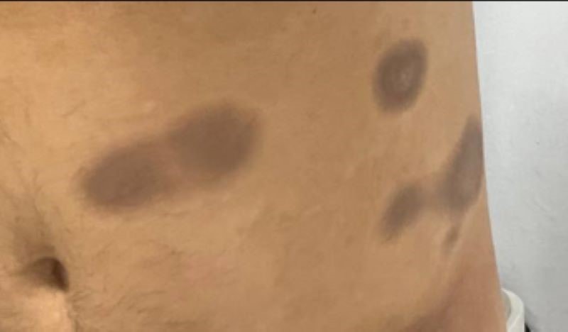 Dị ứng thuốc paracetamol, nam bệnh nhân nổi ban đỏ toàn thân, tổn thương vùng nhạy cảm