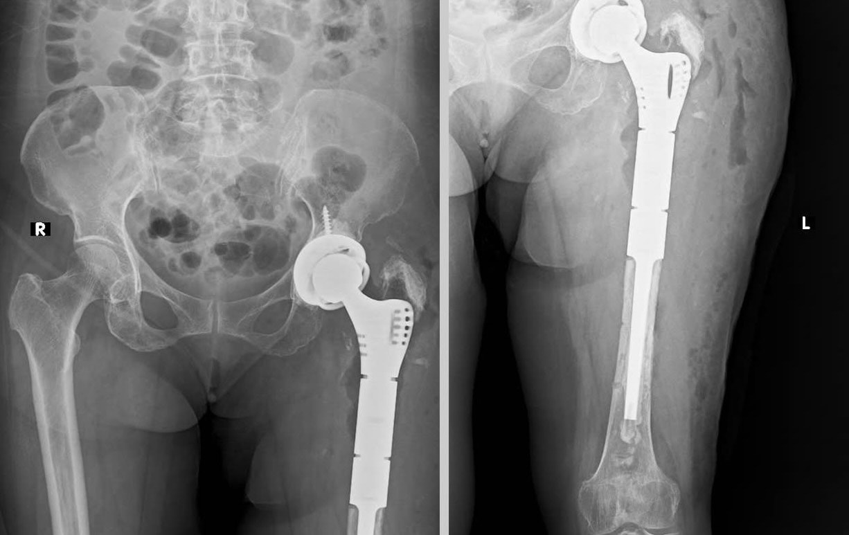 Thay thành công khớp háng và xương đùi bằng kỹ thuật Megaprosthesis tại Huế