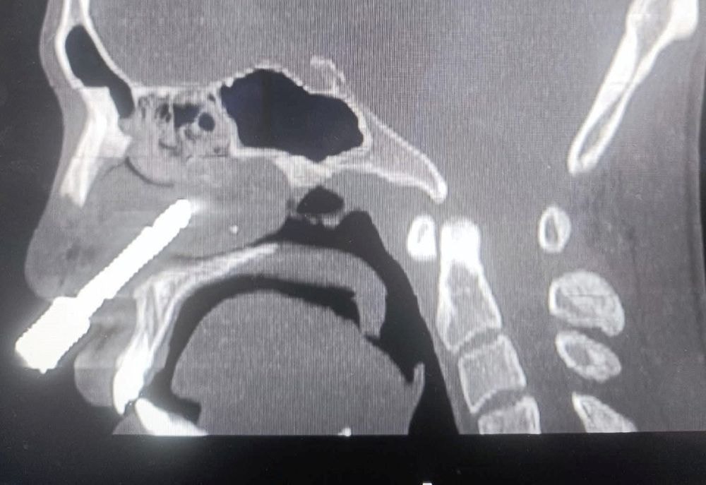Phẫu thuật thành công, lấy mũi khoan 8cm cắm sâu trong mũi bệnh nhân Phẫu thuật thành công, lấy mũi khoan 8cm cắm sâu trong mũi bệnh nhân