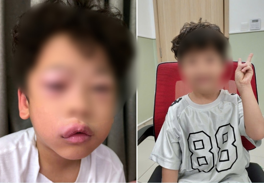 Bé trai bị dị ứng, phù mạch sau khi chơi slime. Ảnh: BVCC
