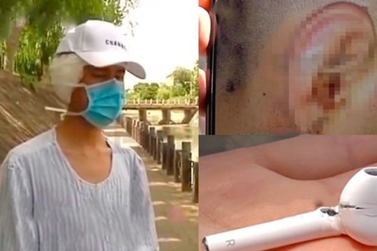 AirPods phát nổ ngay trên tai, một người đàn ông gặp thương tật nặng nhưng bất ngờ lại bị cả cộng đồng lên án
