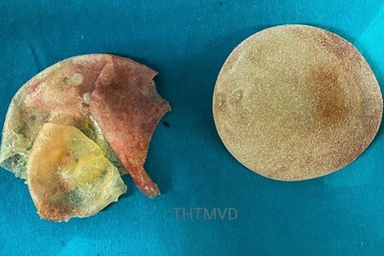 Người phụ nữ bị vỡ túi ngực 5 năm mà không biết