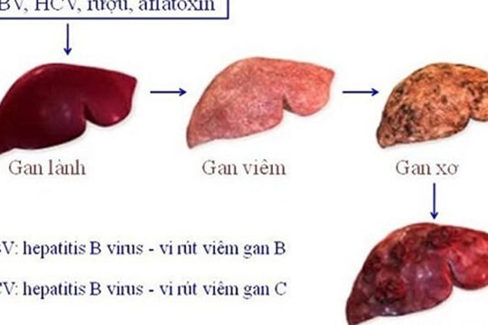 Chàng trai 20 tuổi bị ung thư gan vì bỏ qua điều này