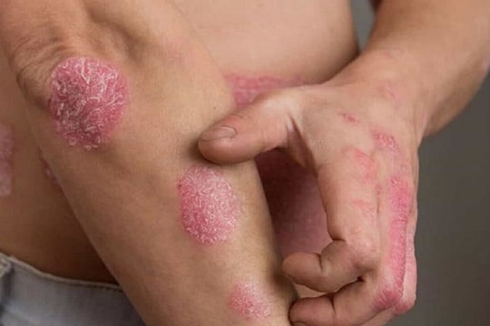 Sau cú sốc tình cảm, nam thanh niên nổi mảng đỏ bong tróc khắp người