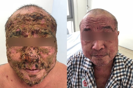 Da mặt người đàn ông nứt toác, cháy đen vì căn bệnh này
