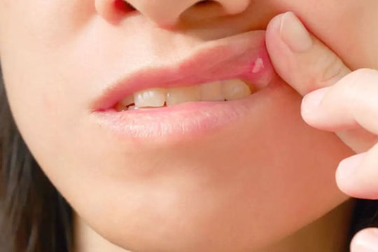Vết loét miệng hay bị bỏ qua có thể là dấu hiệu của ung thư