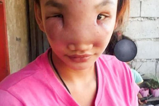 Cô gái xinh đẹp bị biến dạng khuôn mặt và mất thị lực sau một lần nặn mụn