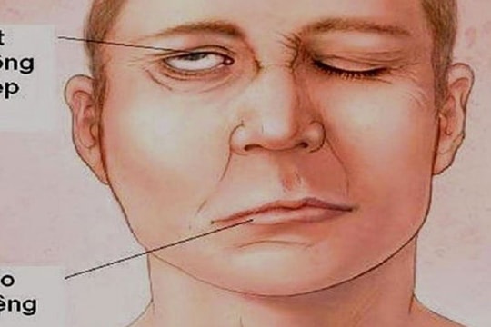 Vừa tắm xong, người phụ nữ bị méo miệng, nói khó