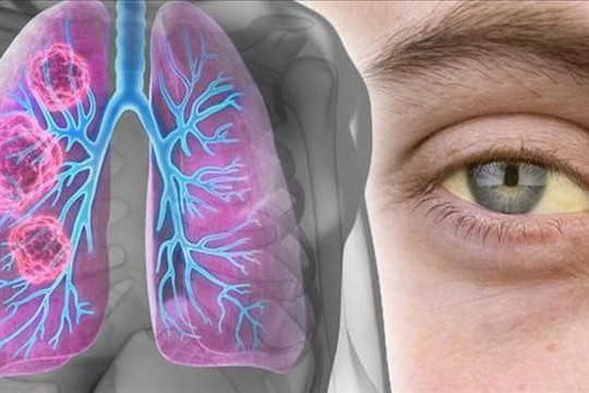 Mắt có hiện tượng này coi chừng bệnh ung thư phổi, bạn cần đi khám càng sớm càng tốt