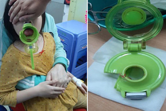 Bé gái 7 tuổi đi cấp cứu cùng bình đựng nước uống kẹt lưỡi