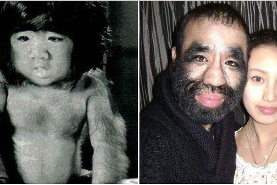 Cuộc sống hiện tại của cậu bé mọc lông kín người, từng đóng Tây Du Ký sau 43 năm