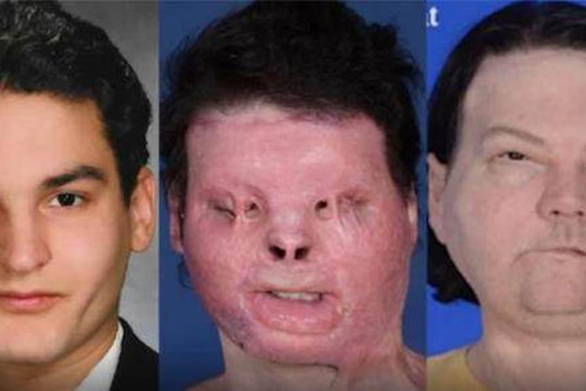 Người được phẫu thuật thay khuôn mặt thành công đầu tiên trên thế giới