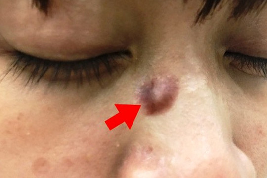 Hai người phụ nữ bị ung thư da từ nốt ruồi ở mặt, bác sĩ khuyên để tránh bệnh này hãy làm những điều sau