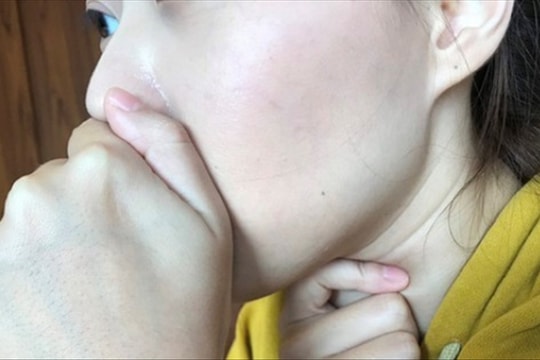 Sốt kéo dài 2 tuần, cô gái 20 tuổi được chẩn đoán suy tim, suy gan, có nguy cơ đột tử