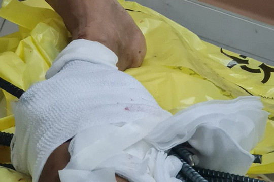 Đang chạy xe trên đường, chàng trai 31 tuổi bị 11 cây sắt dài đâm vào chân