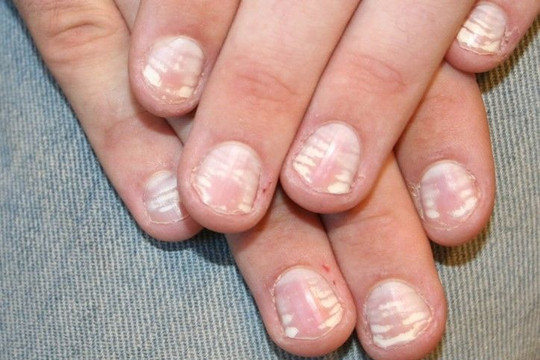 Đốm trắng trên ngón tay nói lên điều gì về sức khỏe?