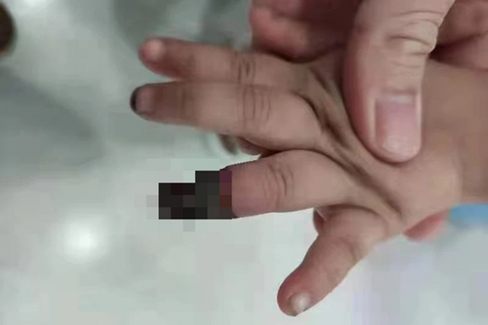 Cháu gái 3 tuổi bị hoại tử phải cắt ngón tay vì hành động sai lầm của bà, hình ảnh được chia sẻ khiến phụ huynh đau xót