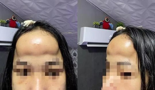 Vừa buồn cười vừa thương cô gái độn trán như ổi rơi trúng đầu