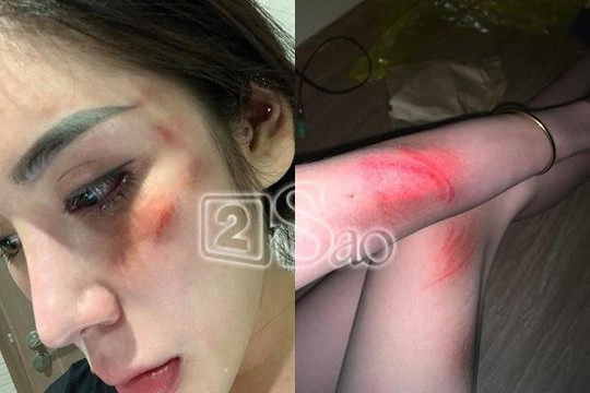 Vụ hot girl bị đánh đập: Đáng sợ phản ứng từ chồng sắp cưới