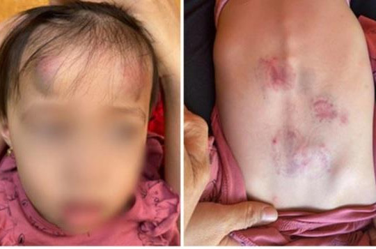 Bé gái 2 tuổi bị bạn đánh thâm tím: Cô giáo không biết, dân mạng phẫn nộ