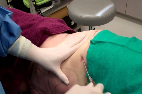 Bác sĩ thẩm mỹ tiết lộ rủi ro đáng sợ khi hút mỡ bụng không đúng kỹ thuật