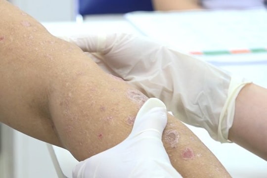 Bệnh nhân vảy nến khổ sở vì nỗi sợ Covid-19