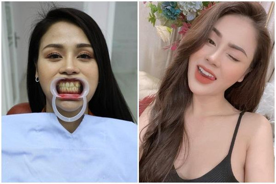 Lương Thu Trang 'ê chề' vì ngã gãy răng khi quay 'Mặt Nạ Gương'