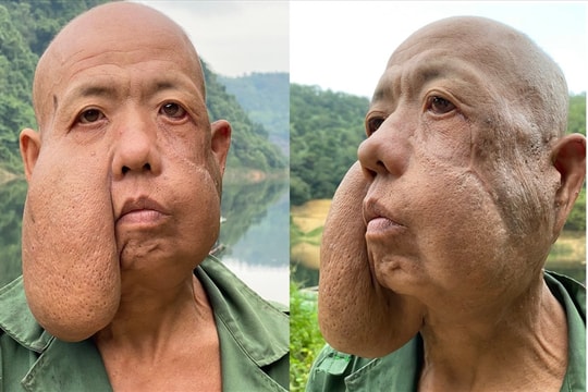 Cắt khối u khổng lồ, trả lại "gương mặt người" cho người đàn ông 52 tuổi