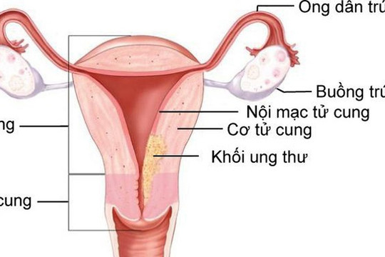 Ung thư nội mạc tử cung có phát hiện sớm được không?