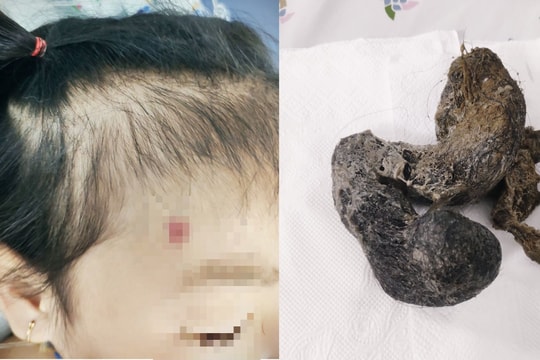 Bé gái 4 tuổi cấp cứu vì hội chứng 'cô bé tóc mây' hiếm gặp
