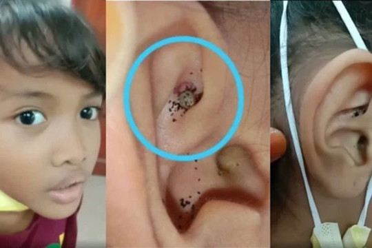 Cậu bé 6 tuổi đau nhức và nghe tiếng động lạ trong tai, đi nội soi bác sĩ hốt hoảng khi thấy con vật đang ''làm tổ'' bên trong